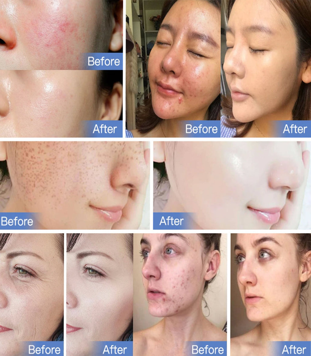 Seven-Color LED Light Therapy Device for Skin Renewal - Souliia