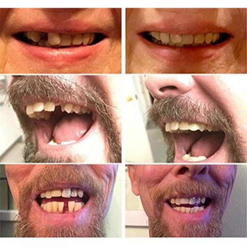 Temporary Cosmetic False Teeth — Natural-Looking Smile Veneers