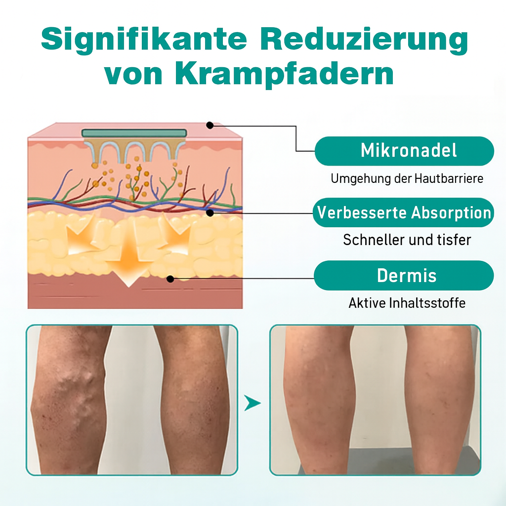 VenoLift Patches – Helpotusta kivuliaisiin, näkyviin laskimoihin – Souliia